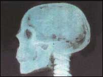 skull